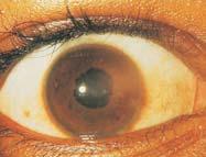 Uveitis Acute anterior uveitis usually clears spontaneously or after local therapy with corticosteroids Chronic uveitis may lead to adhesions between the iris and the lens (synechia) Glaucoma