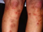 Skin Rash Papules,nodules, plaques Erythema