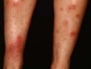 common skin manifestation Usually acute,