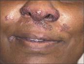 Lupus pernio Most characteristic of sarcoidosis Typically