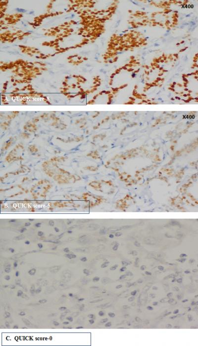 visualized using di-aminobenzidine as a chromogenic substrate. For each run of staining, a positive control slide was prepared from breast carcinoma known to be positive for the proteins studied.