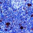 Liver Cancer Liver Cancer A-1-Antichymotrypsin S100A9, EP185 A-1-Antitrypsin SALL4 6E3 Alpha-Fetoproten BSB-23