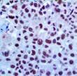 Perforin 5B10 S100A9, EP185 Fli-1 HHV-8 Sarcoma & Soft Tissue Actin, Muscle Specific HHF35