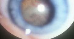 Stage V - inoperable retinal detachment End stage eye