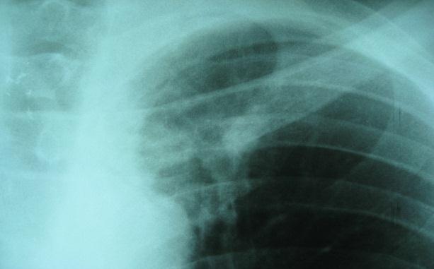 Systematic screening for active TB should be considered in people with untreated fibrotic CXR lesion. 6.