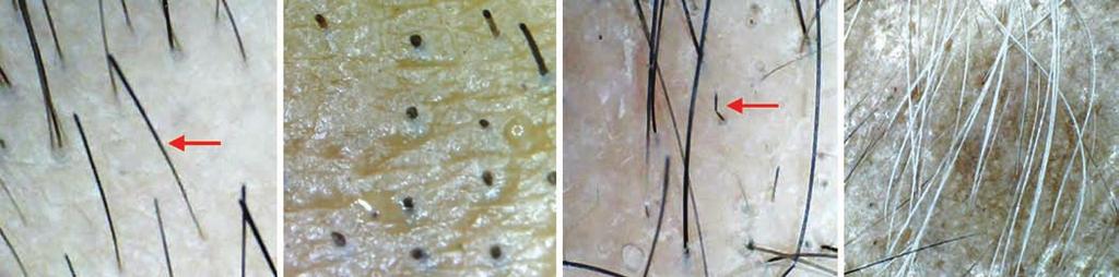 Pooja Agrawal et al A B C D Figs 2A to D: Dermatological signs of AA: (A) Exclamation mark hair; (B) cadaver hair; (C) coudability sign; and (D) sparing of gray hair in AA patch Table 1: Diagnostic