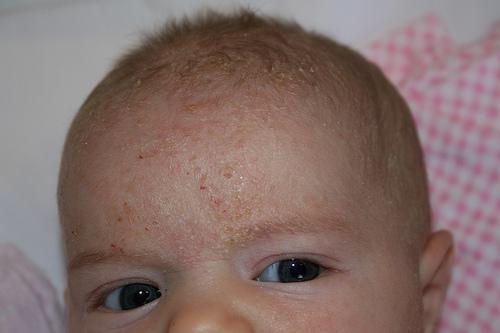 Seborrheic Dermatitis Began on the scalp and is now