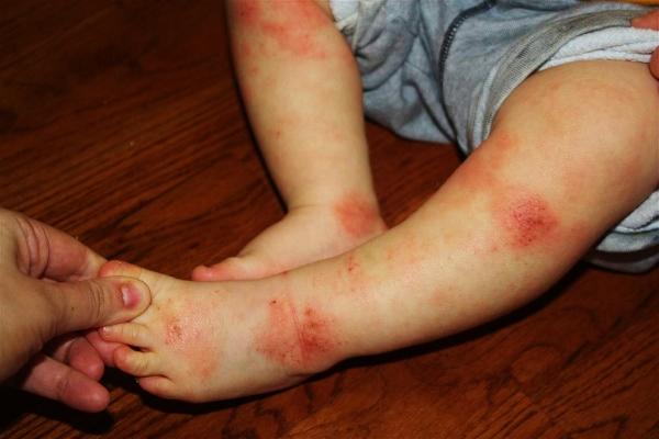 Atopic Dermatitis Commonly affects the