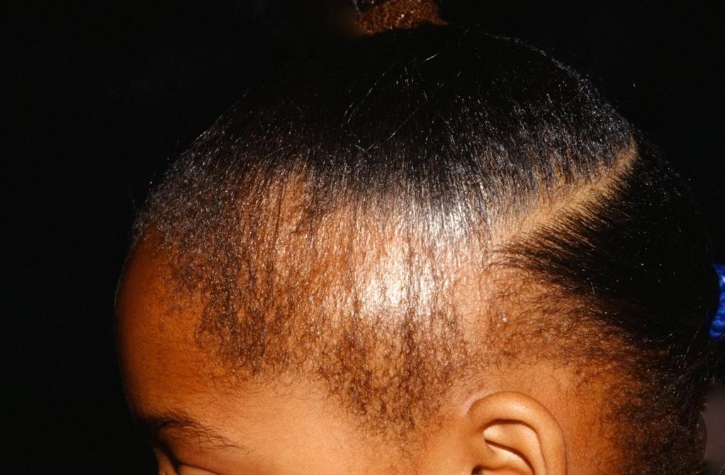 Traction Alopecia Hair loss along lines of tension Regional adenopathy is