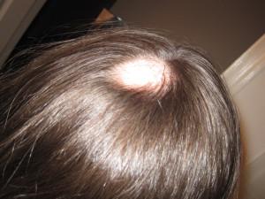 Alopecia Areata Single patch of hair loss over the last few days No recent stressful