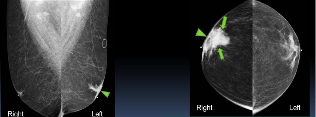 Fig. 8: Mammograms show an irregular mass (arrows). Ultrasound shows an ill-defined, hyperechoic mas with central irregular hypoechoic Incidentally seen is mild gynecomastia on mammograms.