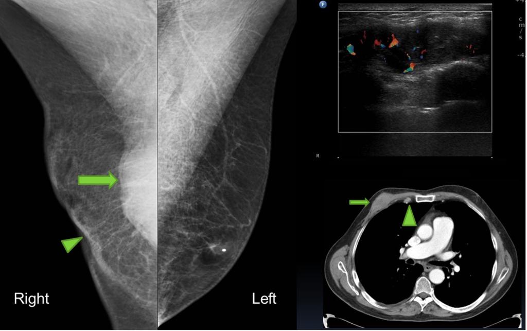 The second figures shows skin thickening (arrowhead) and eccentric location of cancer in a male patient with right breast cancer (arrows). Fig.