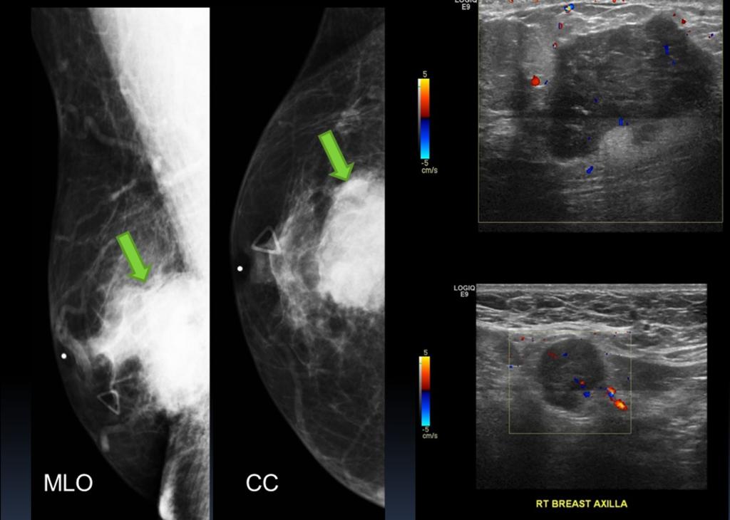 CT chest, the mass is posterior and fixed to the chest wall (arrow). An enlarged internal mammary lymph node is also seen (arrowhead). The biopsy showed recurrent invasive ductal carcinoma. Fig.