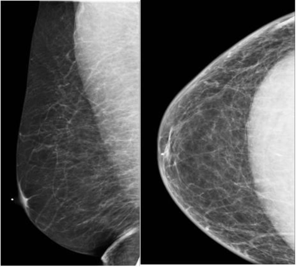 Fig. 4: MLO and CC views of the right breast in a male patient