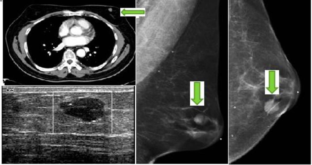 Fig. 5: An axial slice from a chest CT scan shows a soft tissue mass (arrow) incidentally in the left breast of a male patient.