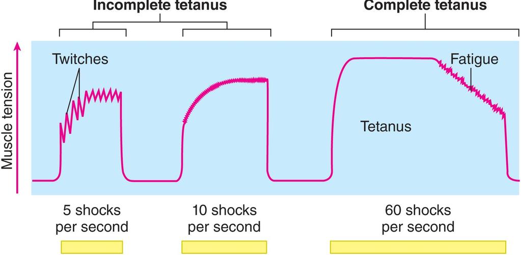 Tetanus Smooth, sustained contraction with