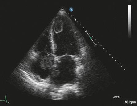 Review article 150 Echocardiography is not only essential for diagnosis and risk assessment of patients with acute dyspnoea due to a cardiomyopathy, but may also be valuable for proper haemodynamic