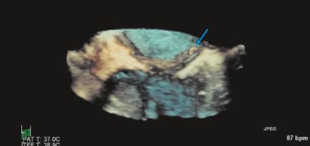 Doppler echocardiography can accurately identify the level of obstruction, the presence of a significant mitral regurgitation caused by systolic anterior motion of mitral leaflets and the effect of