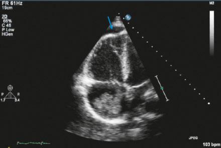 the cases with pulmonary embolism, and signs of right ventricular dysfunction may be present in patients with right ventricular myocardial infarction or pulmonary hypertension (fig. 7).