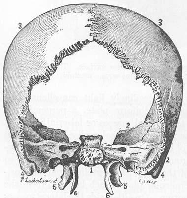 Sphenoid bone from the rear, with Parietal (3) and Temporal bones (4, mastoid process) attached.