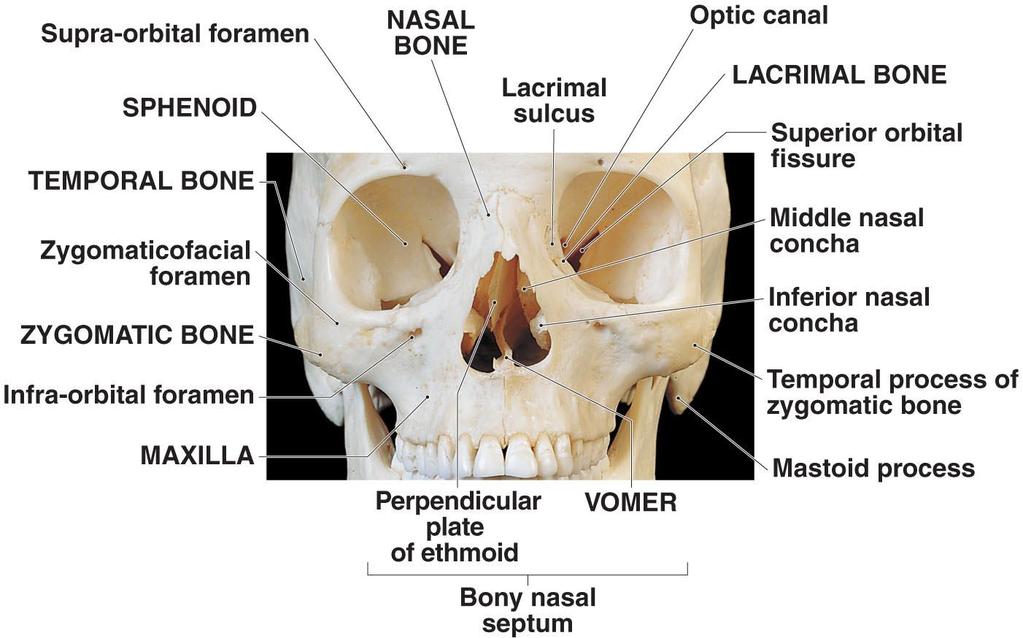 If the perpendicular plate of the ethmoid bone is displaced from its medial position