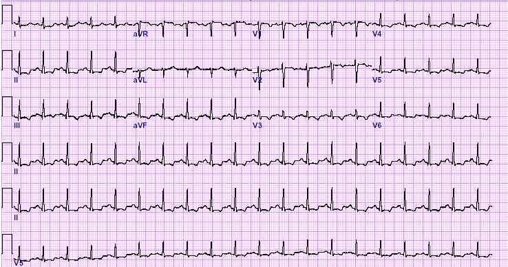 ECG: Sinus tach at 120, nonspecific ST-T changes (unchanged from baseline except HR) Patient