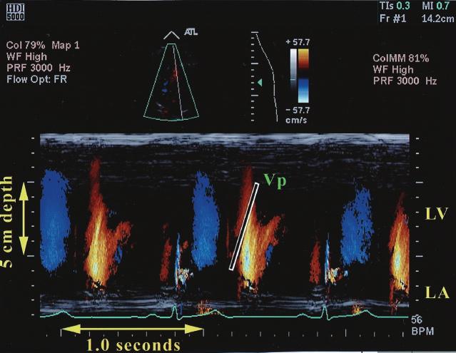 1666 Firstenberg et al. JACC Vol. 36, No. 5, 2000 Echocardiographic Assessment of Filling Pressures November 1, 2000:1664 9 Figure 1. Representative color M-mode image demonstrating Vp determination.
