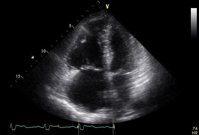 Initial Evaluation PFTs Echocardiogram FVC