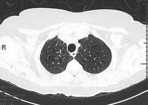 Re-evaluation of Underlying Lung
