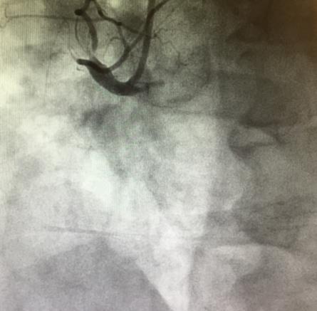 old man with inferior STEMI.