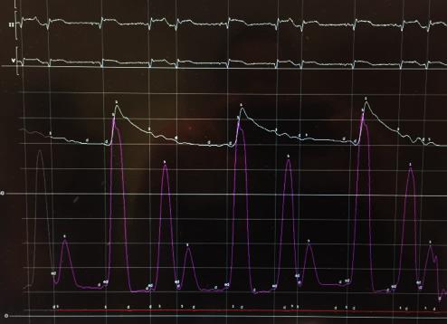 DDx for Polymorphic VT during VA-ECMO Support LV Distention or LAD ischemia?