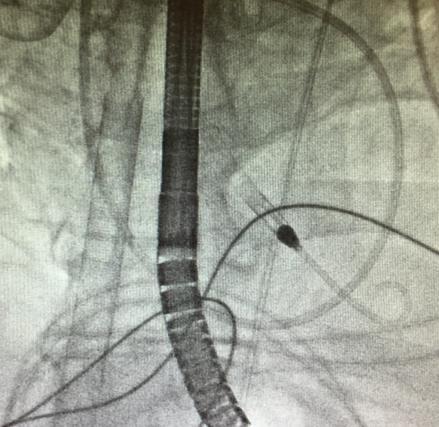 Impella for LV vent should be at