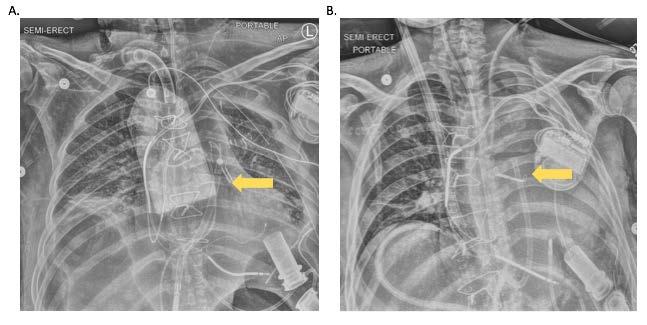 Surgical RVAD versus percutaneous RVAD: our experience Percutaneous alternatives to surgical RVAD include the Impella RP and the Protek Duo Impella RP is a microaxial intra-corporal device