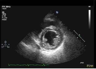RVAD weaning parameters- on echo Short axis view is key No RV bulging into the LV During echo weaning test, evaluate both ventricles