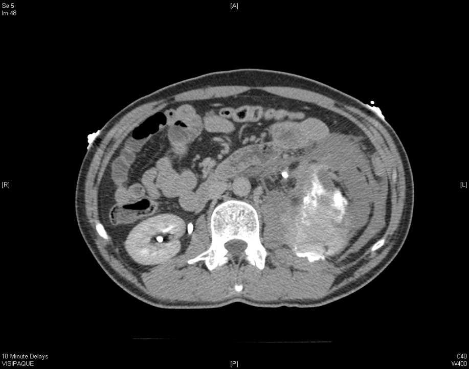 CT scan demonstrates renal laceration. SBP decreased to 84 Patient transfused O+ P RBC. HCT 21 Taken to angio for embiolization.