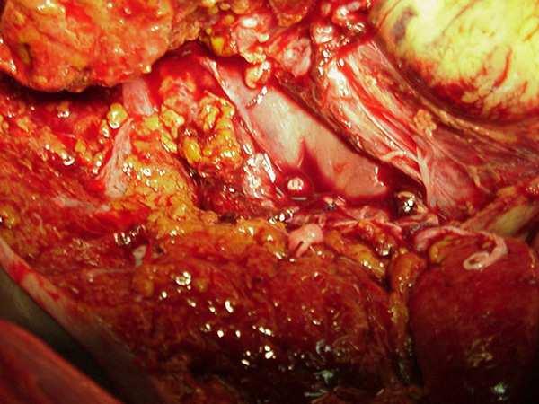 Abdomen left open with Vac-Pac dressing.