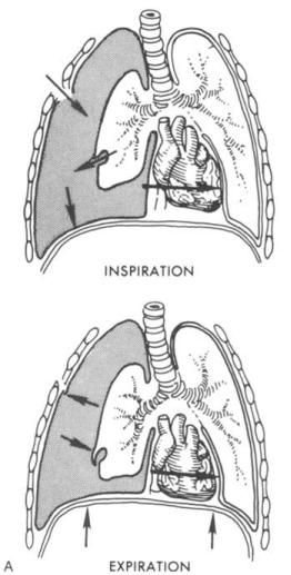Types of Pneumothorax Tension Pneumothorax Injury to pleura creates a tissue flap that opens on inspiration and closes on expiration(ball valve