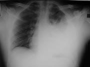 Hemothorax Radiograph