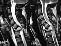 Secondary Survey Cervical Spine MRI of