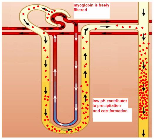 Rhabdomyolisis - ARF Myoglobin precipitates