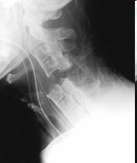 A Airway The reported incidence of cervical spine injury in the setting of major trauma is 1.5% 4%.