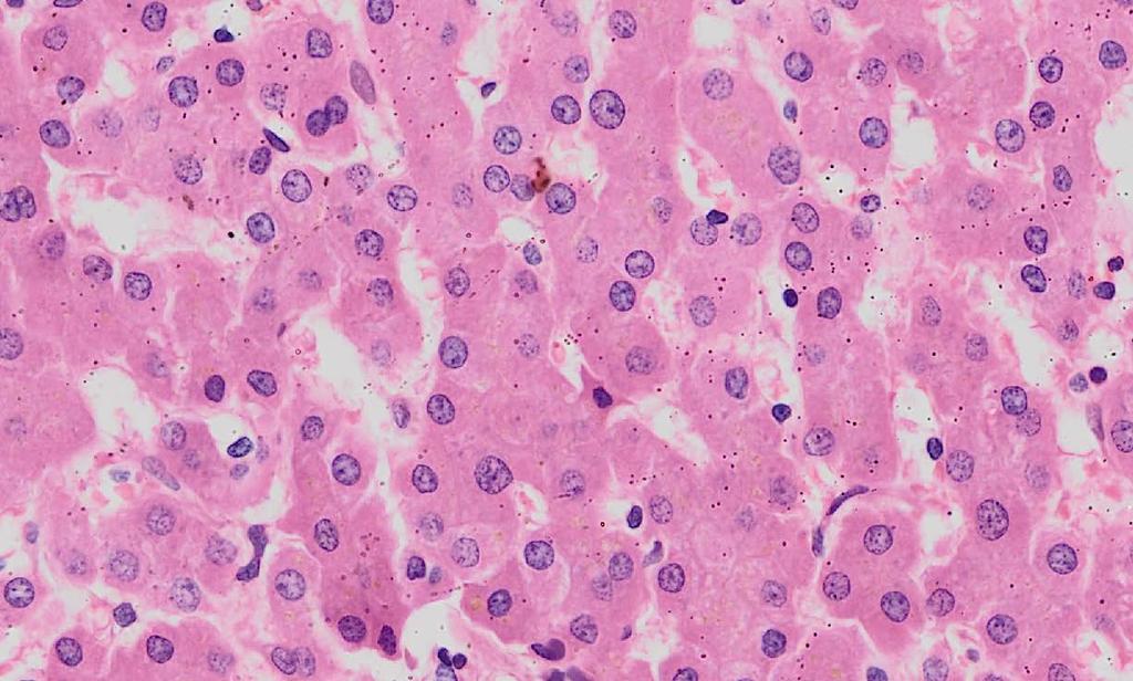 Haemosiderin (yellow-brown particles) Liver