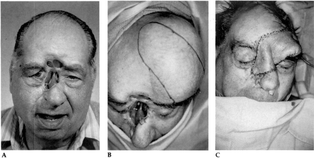 Dermatol Surg Oncol BAKER AND SWANSON 137 TISSUE EXPANSION FOR MIDFACIAL DEFECTS 2994;20:233-240 A B C Figure 3. A) Defect of midface following removal of extensive basal cell carcinoma.