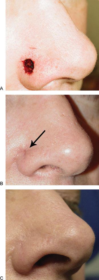 Successes, Revisions, and Complications in Mohs Defect Repairs Sclafani et al. 365 Conclusion Figure 2 (A) Mohs defect of the nasal ala repaired with a rotation flap.