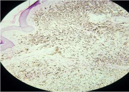 and basaloid cells and there were multiple horn cysts( Figure 1). There was a single case of Spitz nevus (Figure 2).
