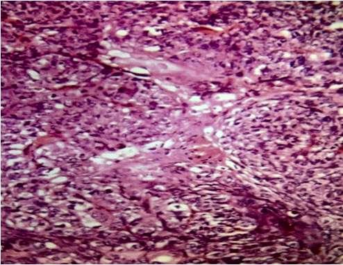 464 Shilpa V. Uplaonkar et. al. / Histopathological Study of Tumours of Epidermis and Epidermal Appendages There was a rare case of sebaceous carcinoma (Figure 8) found over the trunk in a 54 yrs.