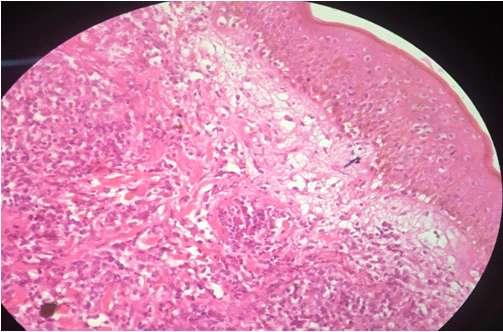 Few mitosis and coarse fibrosis were noted and confirmed with CD4. Fig. 8: Sebaceous carcinoma.