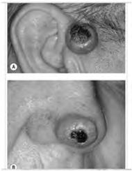 Keratoacanthoma Variant of SCC Rapidly enlarging papule that evolves into a crateriform