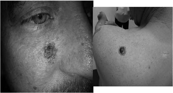 Melanoma The ABCDE s of Melanoma ASSYMETRY: -If you were to