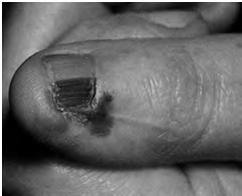 Pigmented nail streaks Possibility of melanoma should be considered for all pigmented nail bands in fairskinned